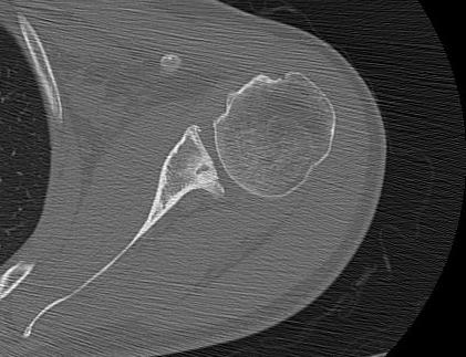 Posterior Instability Glenoid Retroversion